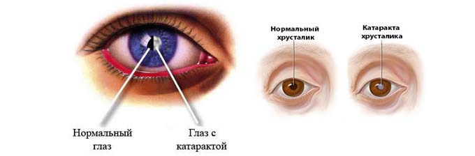 катаракта хрусталика