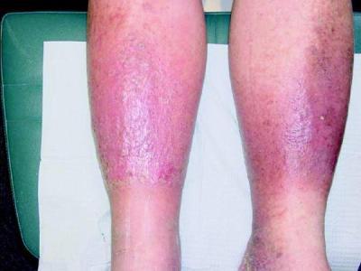 Лечение варикоза ног в зависимости от стадии заболевания