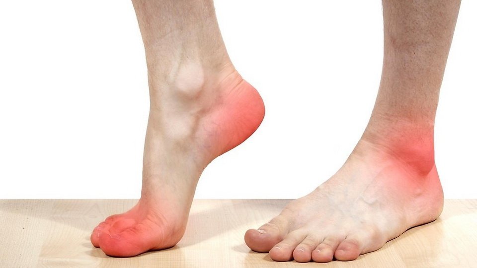 Облитерирующий атеросклероз сосудов ног