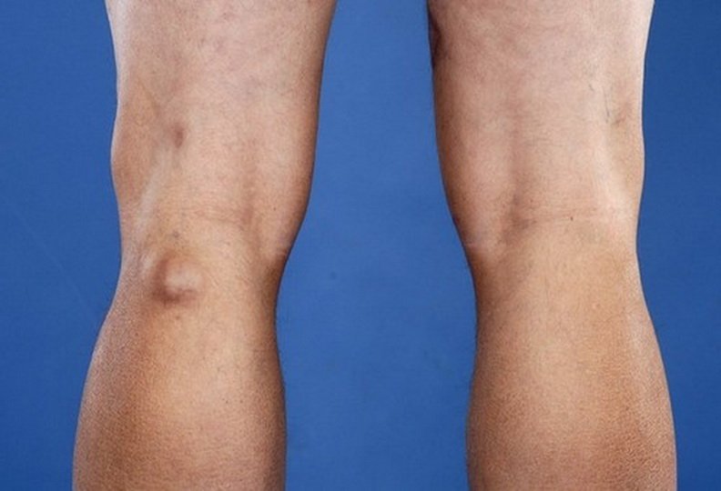 Уплотнения на ноге в районе колена