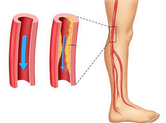 Симптомы и лечение артериопатии нижних конечностей
