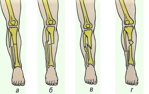 Сколько ходить в гипсе при переломе берцовой кости?
