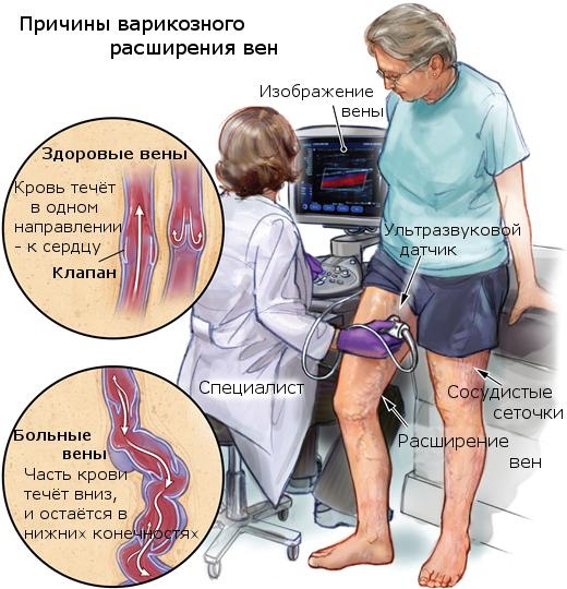 Лечение варикоза ног в зависимости от стадии заболевания