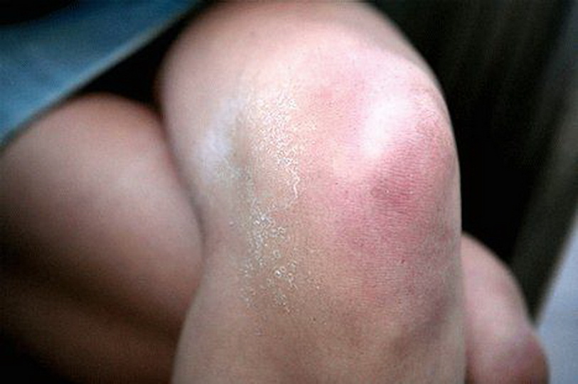 Почему болит и опухает колено без механических повреждений?