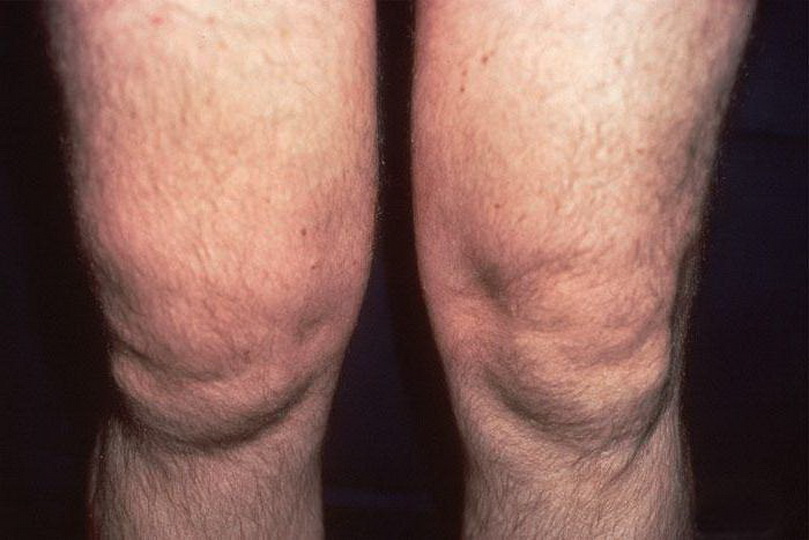 Симптомы и лечение артрита коленного сустава