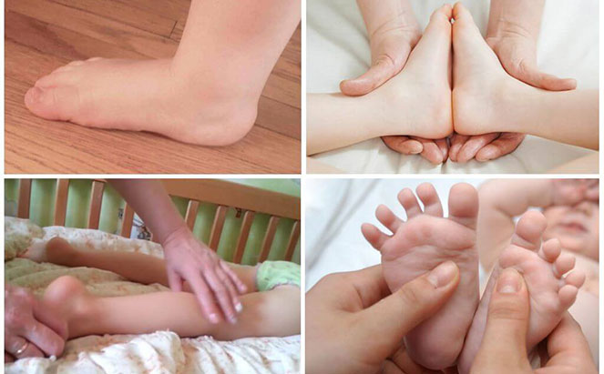 Техника массажа при вальгусной деформации стоп у детей 