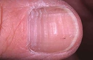 Что означают белые пятна на ногтях ног?