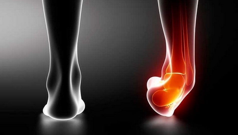 Как лечить травмы, вызванные подворачиванием ноги?