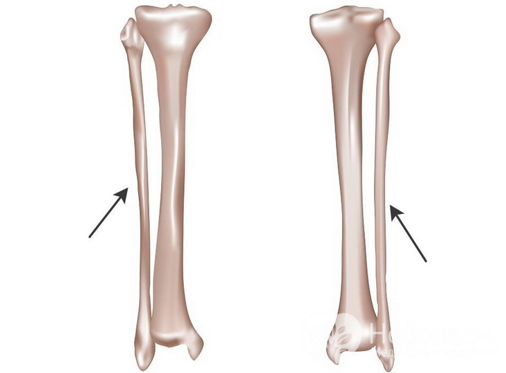 Анатомия и возможные повреждения большеберцовой и малоберцовой костей