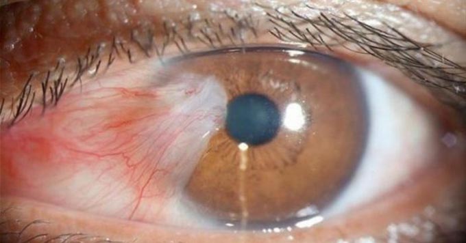 ретинобластома глаза