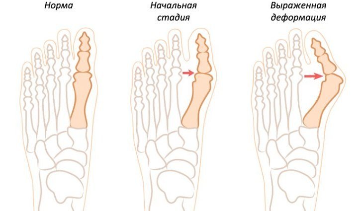 Причины появления и места локализации косточек на ногах