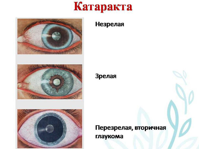 стадии развития катаракты