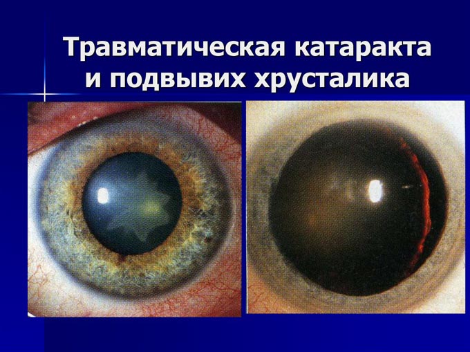 лечение травматической катаракты