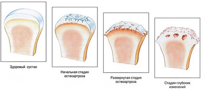 Стадии развития артроза локтевого сустава