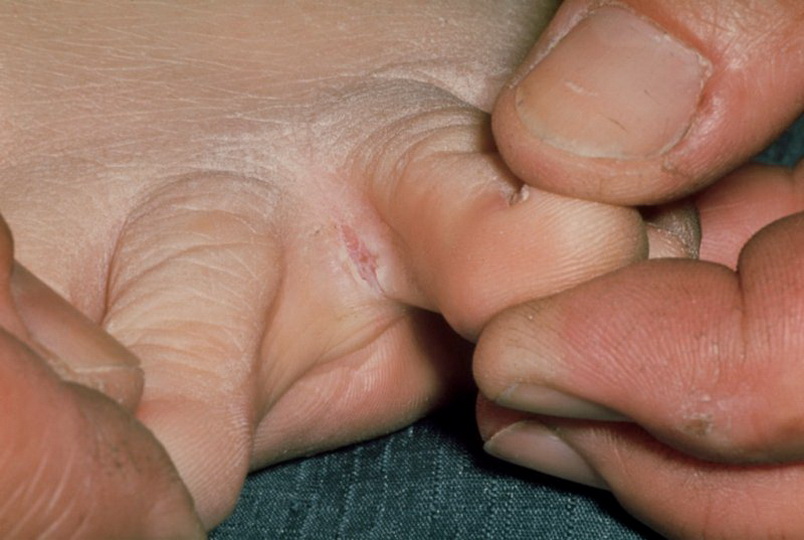 Облазит кожа на ступнях ног: причины шелушения между пальцами, почему слезает кожа